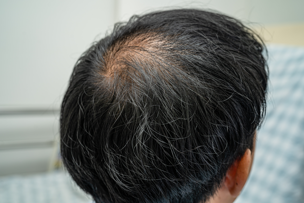 nitric oxide and hair loss